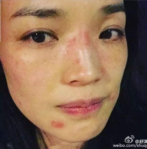 明星花粉过敏视频,镜头下的过敏挑战与应对之道